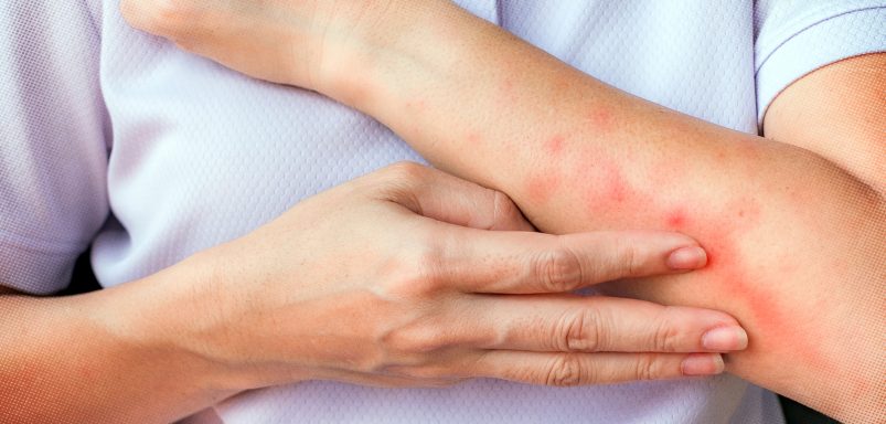 Why scratching a bug bite might feel good but it's a bad idea