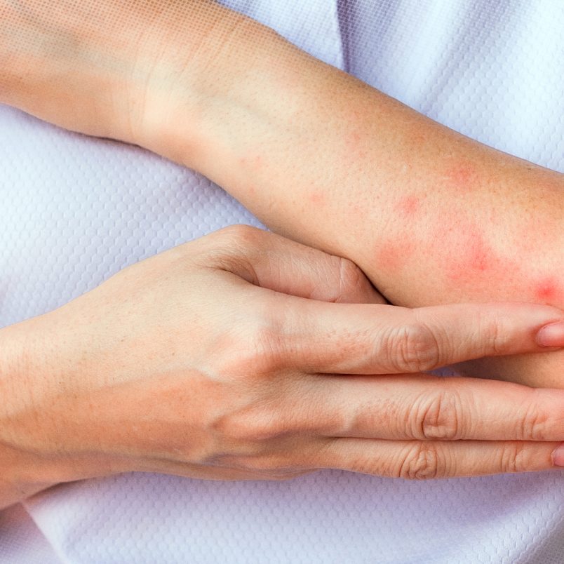 Why scratching a bug bite might feel good but it's a bad idea