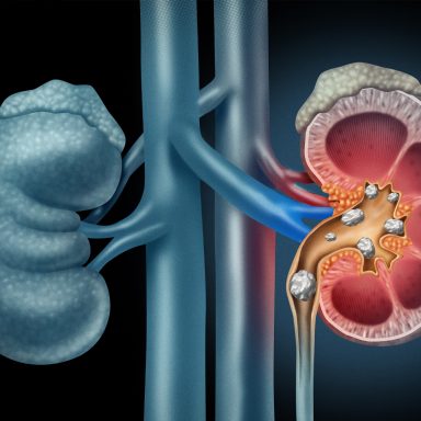 What can cause kidney stones to occur repeatedly and how to prevent it?
