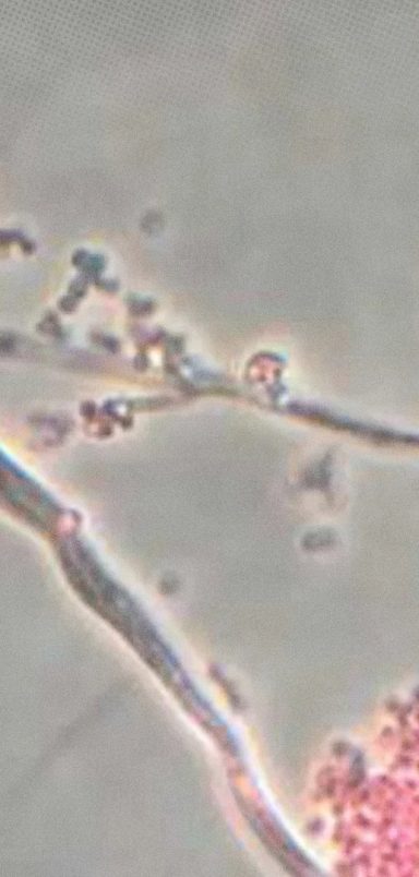 Why could this common Fungus become the world's next big health threat?