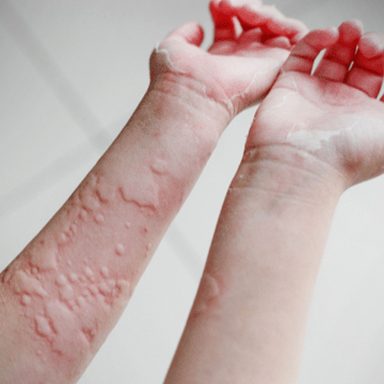 Why your food allergy risk may be increasing