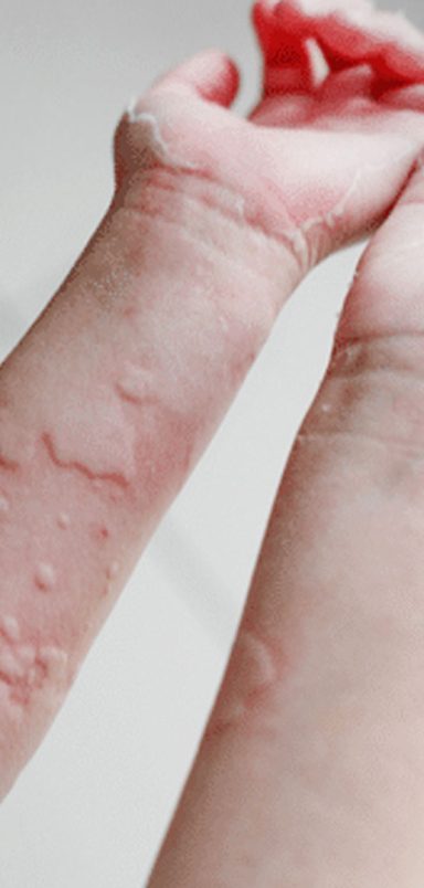 Why your food allergy risk may be increasing