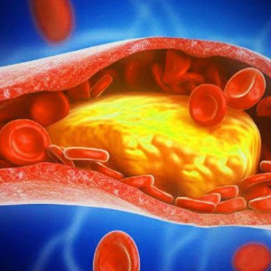 4 foods that raise your cholesterol and harm your heart
