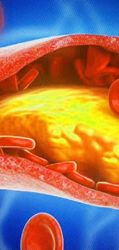 4 foods that raise your cholesterol and harm your heart