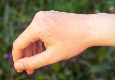 How to spot if you have sun allergy and what is the treatment