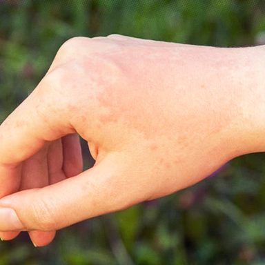 How to spot if you have sun allergy and what is the treatment