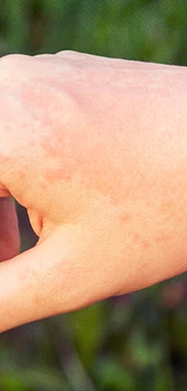 How to spot if you have sun allergy and what is the treatment