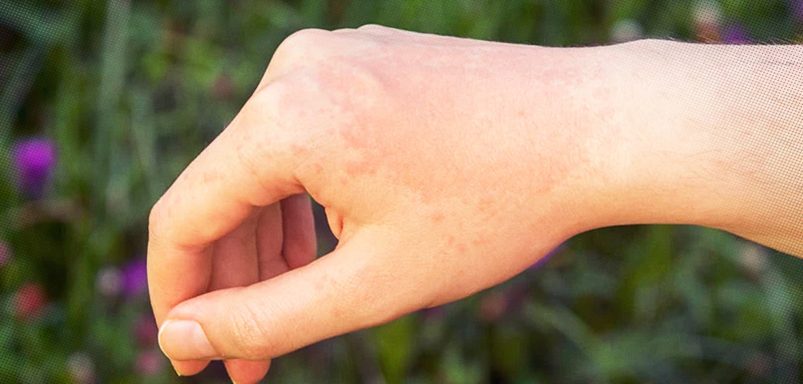 How to spot if you have sun allergy and what is the treatment