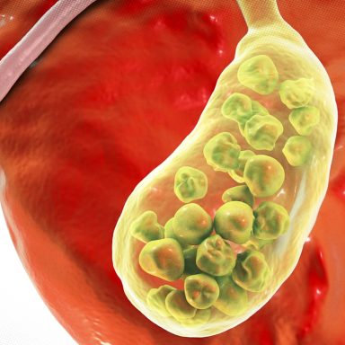 How do gallstones form, what is the identification and treatment process?