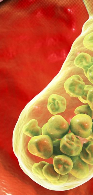 How do gallstones form, what is the identification and treatment process?