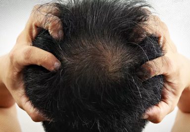 Can stress cause hair loss and how to reverse it?