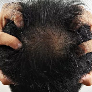 Can stress cause hair loss and how to reverse it?