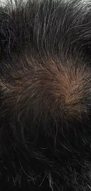 Can stress cause hair loss and how to reverse it?