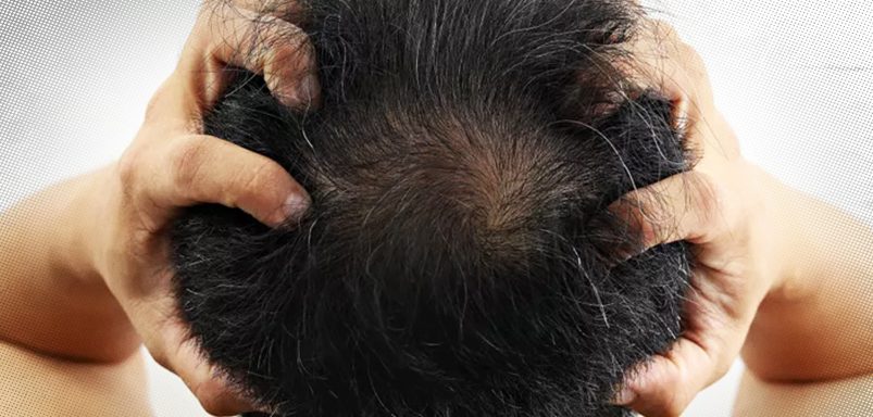 Can stress cause hair loss and how to reverse it?