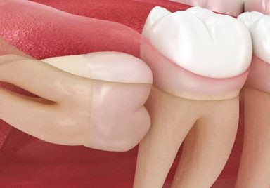 Why do wisdom teeth erupt, and why do they hurt so much when they do?