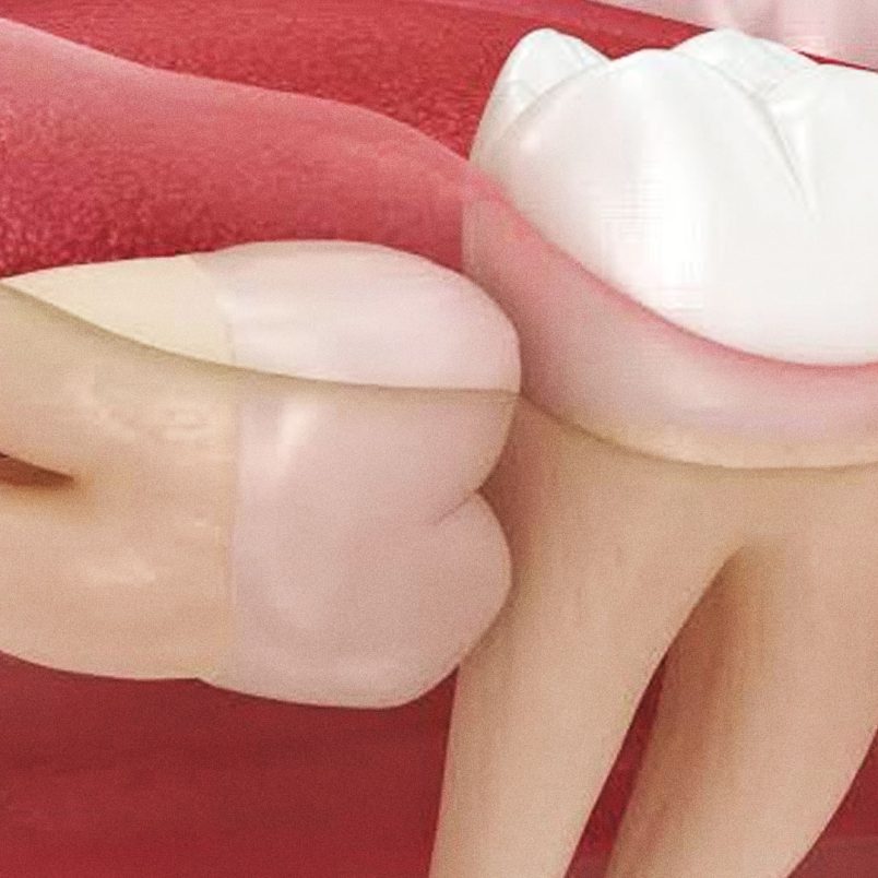 Why do wisdom teeth erupt, and why do they hurt so much when they do?