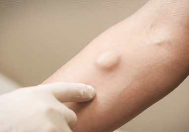 Can a fat lump called lipoma turn into cancer?