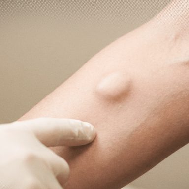 Can a fat lump called lipoma turn into cancer?