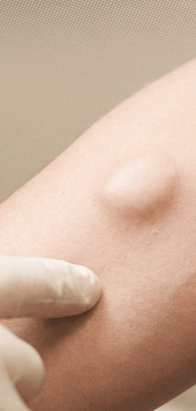 Can a fat lump called lipoma turn into cancer?