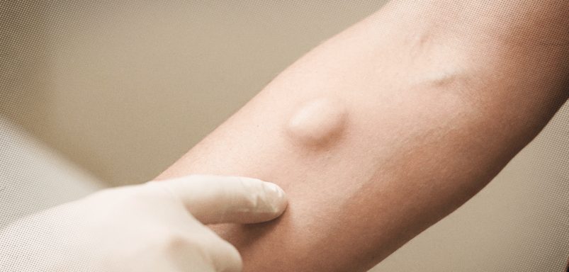 Can a fat lump called lipoma turn into cancer?