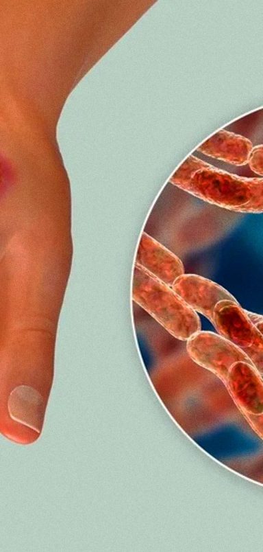 Is Rangpur becoming Bangladesh’s new anthrax hotspot?