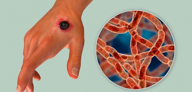 Is Rangpur becoming Bangladesh’s new anthrax hotspot?
