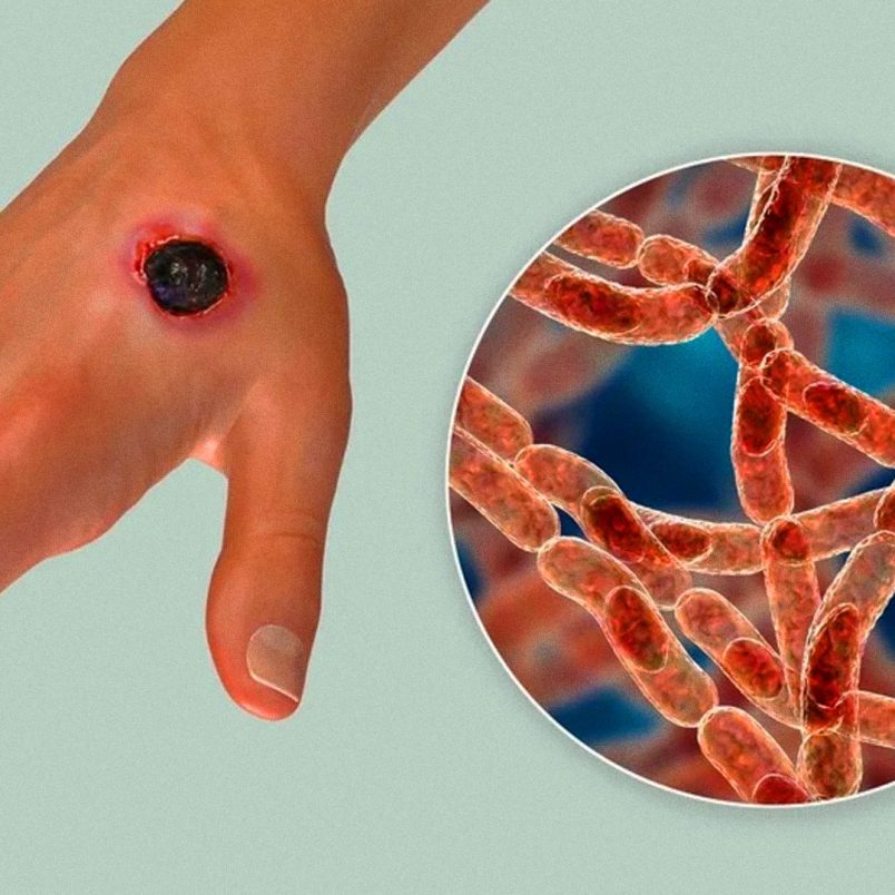 Is Rangpur becoming Bangladesh’s new anthrax hotspot?