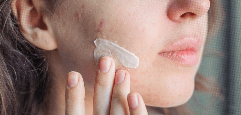 Is it true that toothpaste is an effective spot treatment?